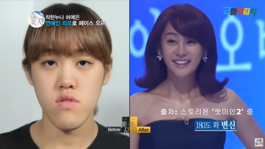 '렛미인2 주걱턱녀' 허예은, 성형 8년후 근황…"인생이 크게 바뀌었다"[종합]