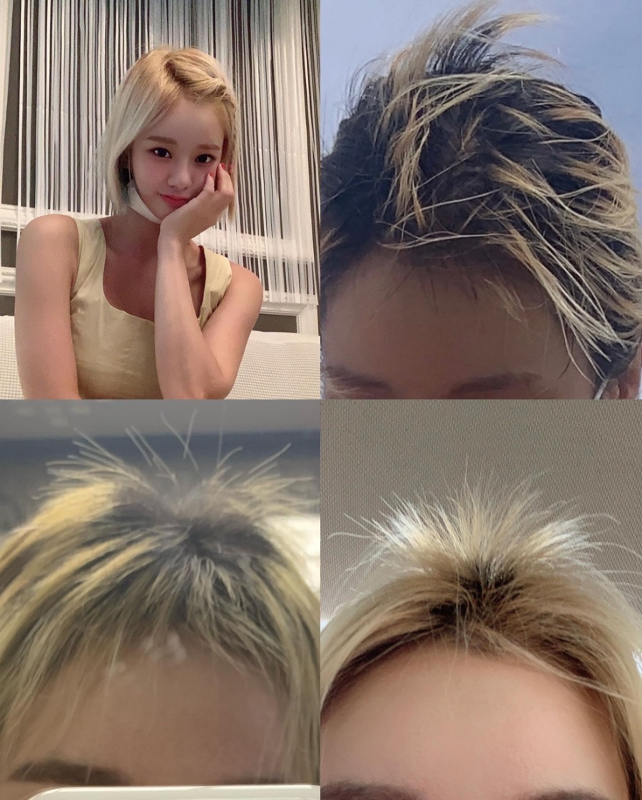 맹승지 "머리카락 45% 뜯겨나가…골룸 같아 삶에 지장, 90살이 된 기분"