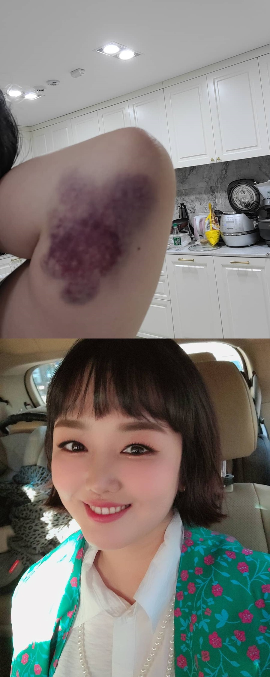 정미애, 팔뚝에 충격적인 피멍…"저에게 무슨 일이"