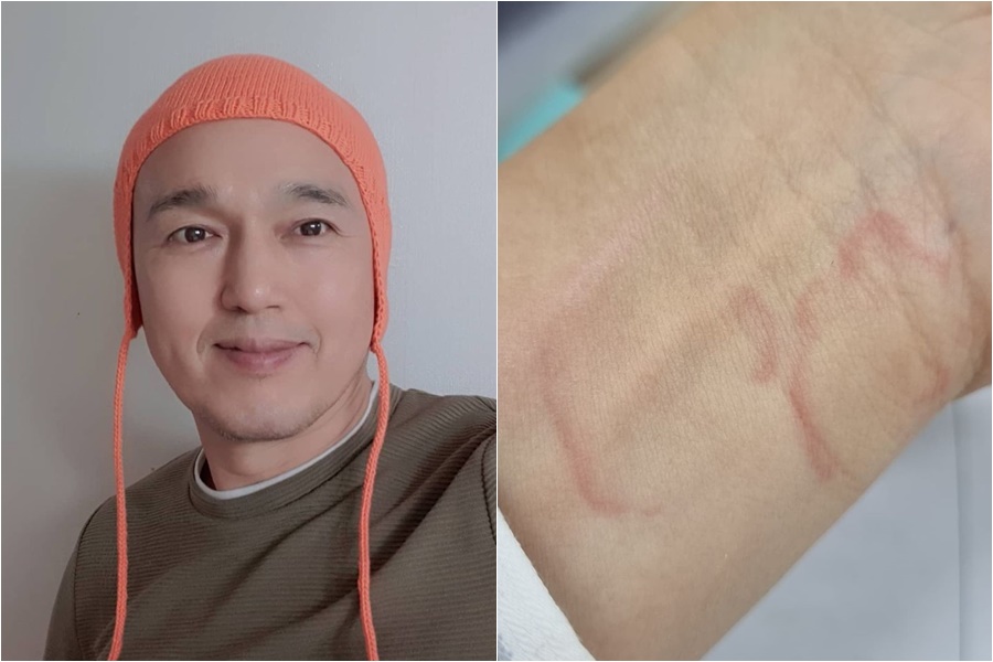 '56세' 김광규, 전세사기 후 '정법' 갔다가 극심한 알레르기…"백약이 무효"