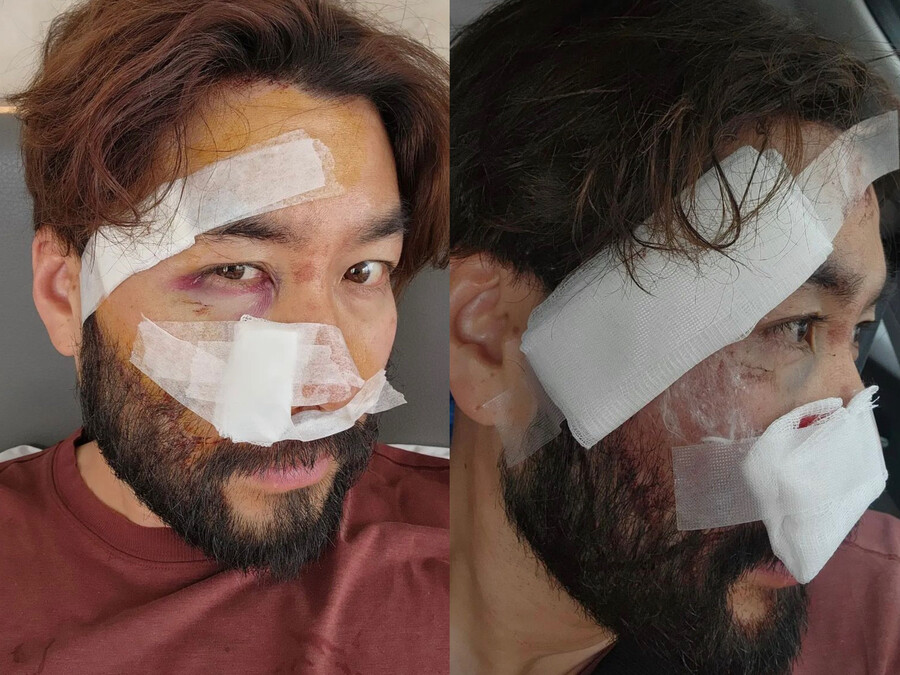 ▲ 오토바이 사고 이후 회복 근황을 알렸던 노홍철. 출처| 노홍철 인스타그램