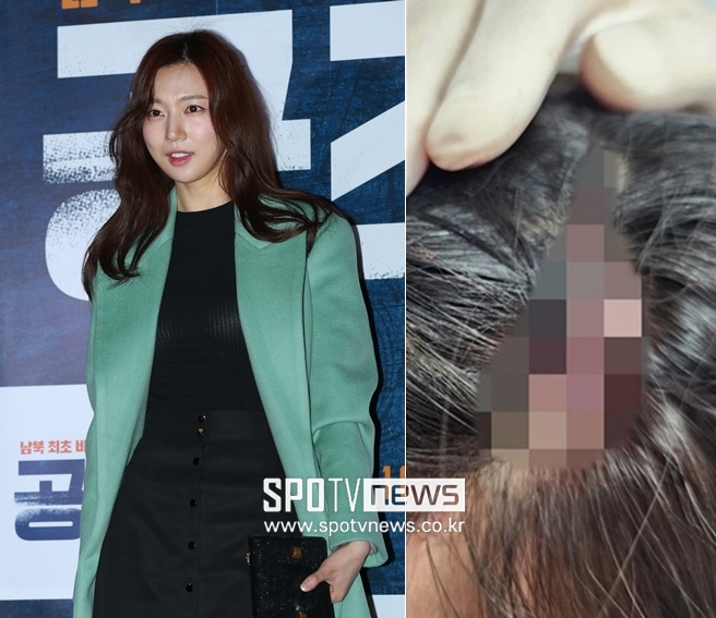 하연주, 드라마 촬영 중 머리 찢어지는 부상 "맞는 장면만 몇 장면인지"