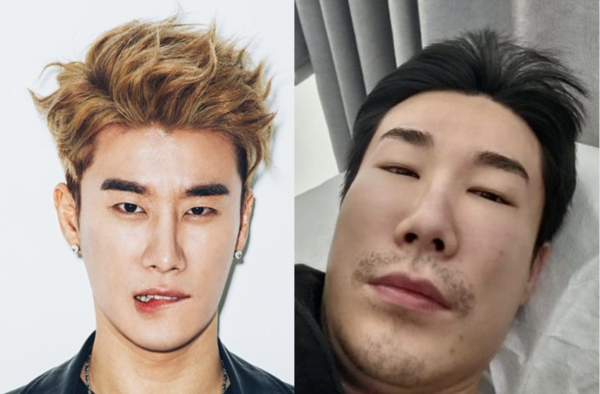 산이, 퉁퉁 부은 얼굴 공개 '부비동염이 이렇게 무서워'