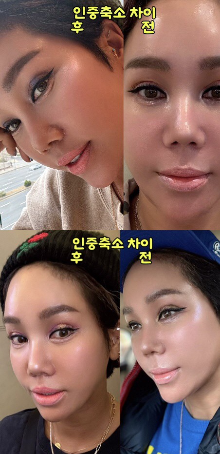 '강원래♥' 김송, 인중 축소 성형 '비포&애프터' 공개..'멘탈 甲'