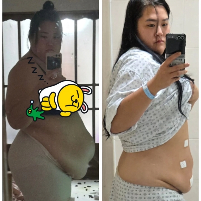 '미나 시누이' 수지, 150kg→99kg..놀라운 '비포&애프터' 공개 "탈장수술도 성공"