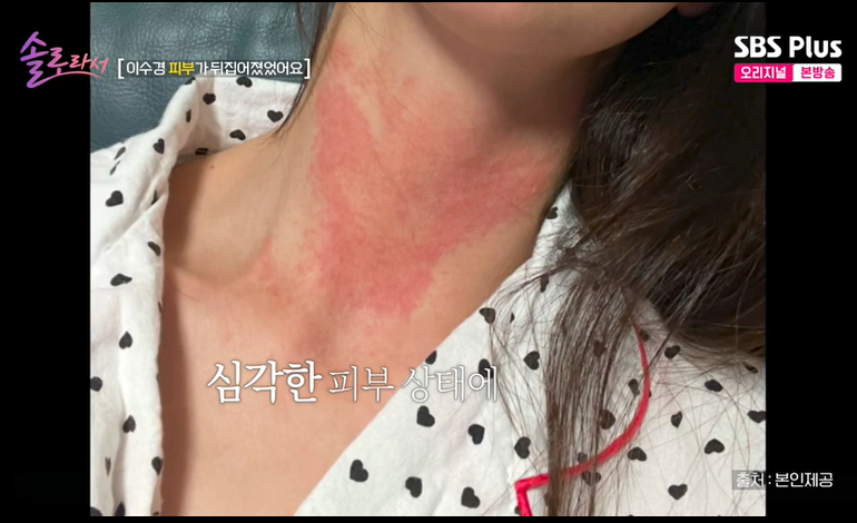 이수경, 피부병에 연예계 은퇴 고민 "우울증에 대인기피증까지"('솔로라서')