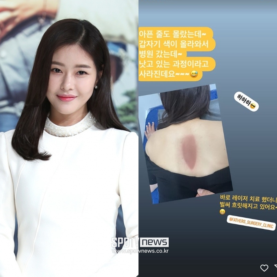 '김태술♥' 박하나, 충격적 등 상태…화상병원行 '날벼락' "낫고 있는 과정"
