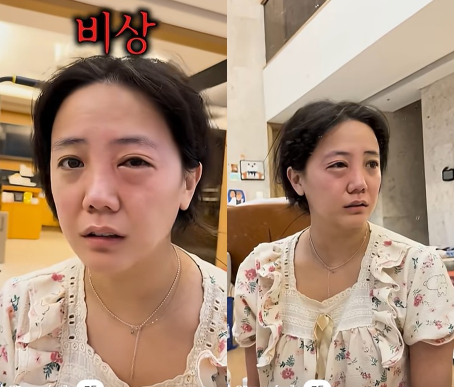 '구축코 재수술' 고은아, 퉁퉁 부은 눈 '비상'…"역대급 알러지"