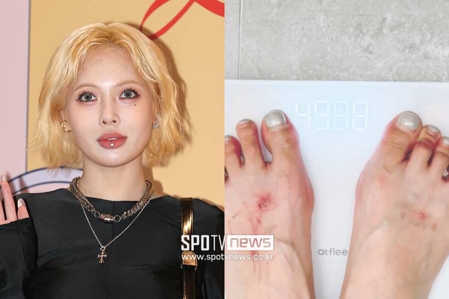 현아, 임신설에 다이어트→49kg 진입…타투 지운 상처투성이 발 '눈길'