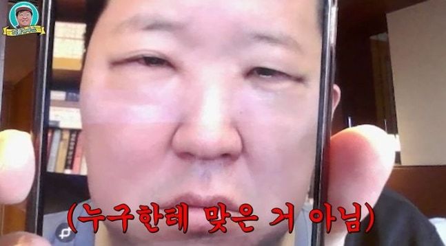 정형돈, 눈밑지방 재배치 수술 직후 공개 “큰 병 앓는 사람 같아“