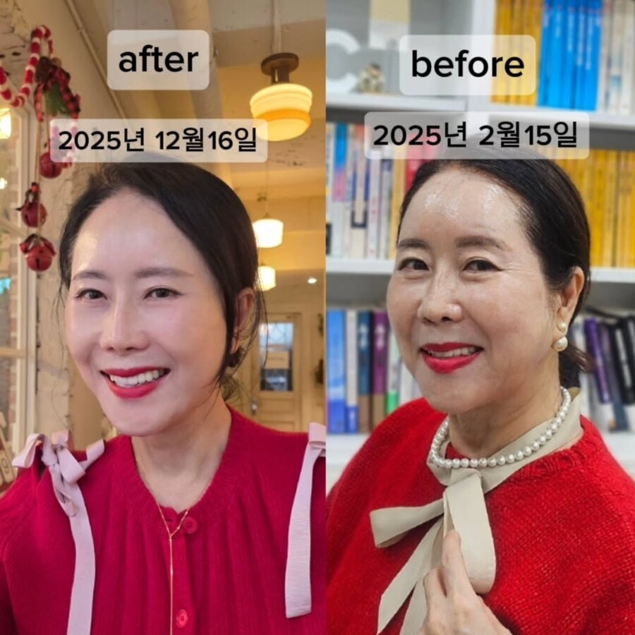 "63살에 인생 리셋" 윤영미, 9kg 감량+안면거상 후기 공개