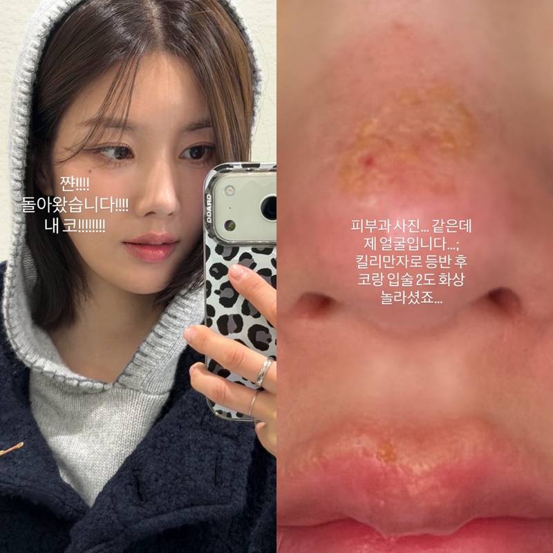 권은비, 코·입술에 2도 화상 '초근접사진 충격'…킬리만자로 등반 후 병원行