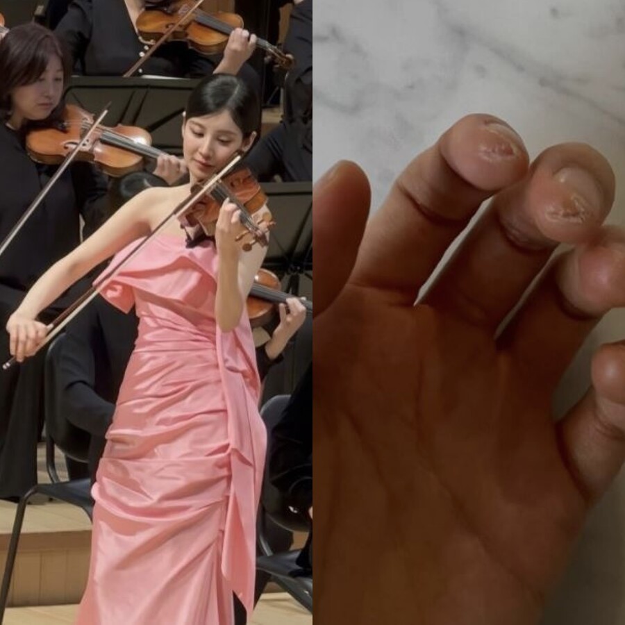 소녀시대 서현, 찢어지고 터진 손가락…특혜논란에 '굳은살 투혼' 화답[이슈S]