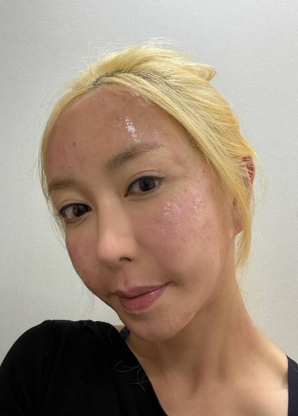 '도박 논란' 슈, 충격적인 얼굴 상태…성한 곳 없는 근접사진