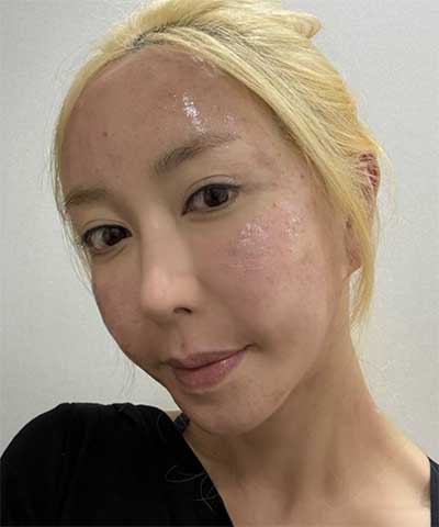 '도박 논란' 슈, 충격적인 얼굴 상태…성한 곳 없는 근접사진