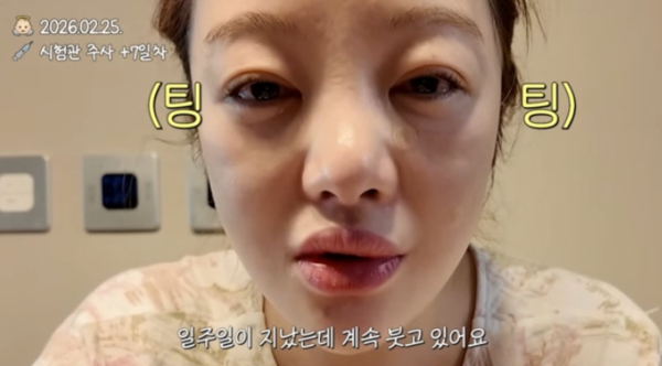 "만신창이" 황보라, 둘째 임신 위한 시험관 시술 부작용…얼굴 퉁퉁·각막손상
