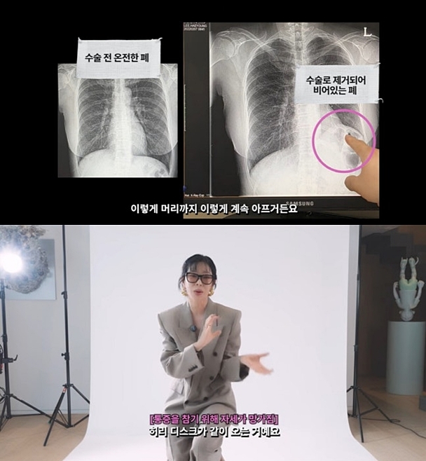 이혜영, 폐암 수술로 '목-허리 디스크' 합병증 "아픔 참느라고.."