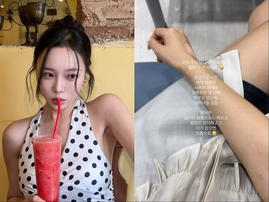 '박성광♥' 이솔이 "여성암 항암으로 왼쪽 혈관 녹아 사용 못 해" 고백