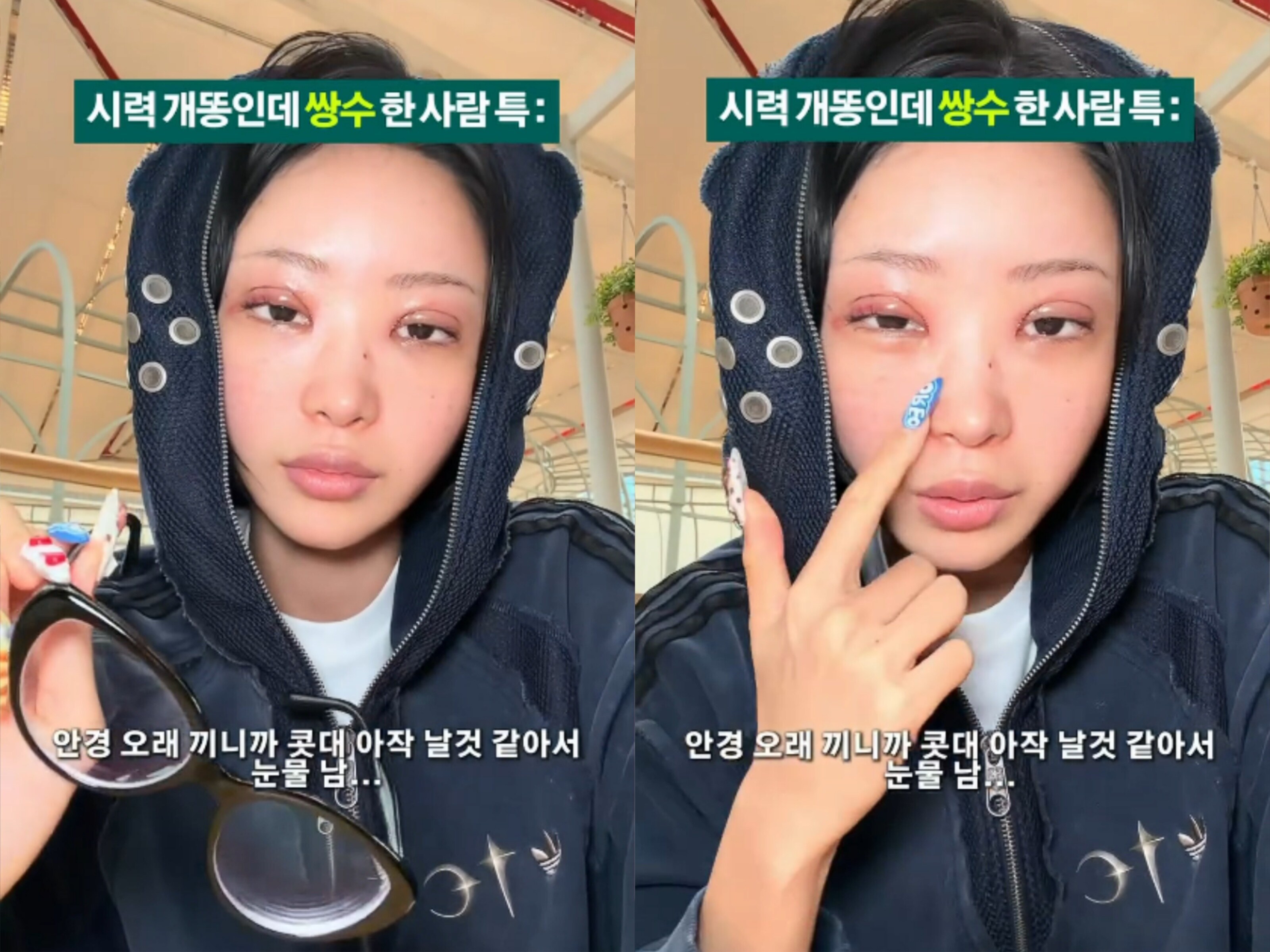 '故최진실 딸' 최준희, 결혼 3달만에 눈 성형→퉁퉁 부었다 "앞이 안 보여" 토로