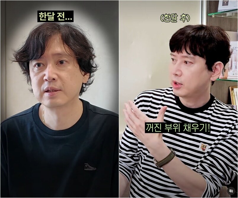 '원조 꽃미남' 김진, 충격적인 노화 근황→시술 후 '30대'로 회춘...'인생 리셋' 성공