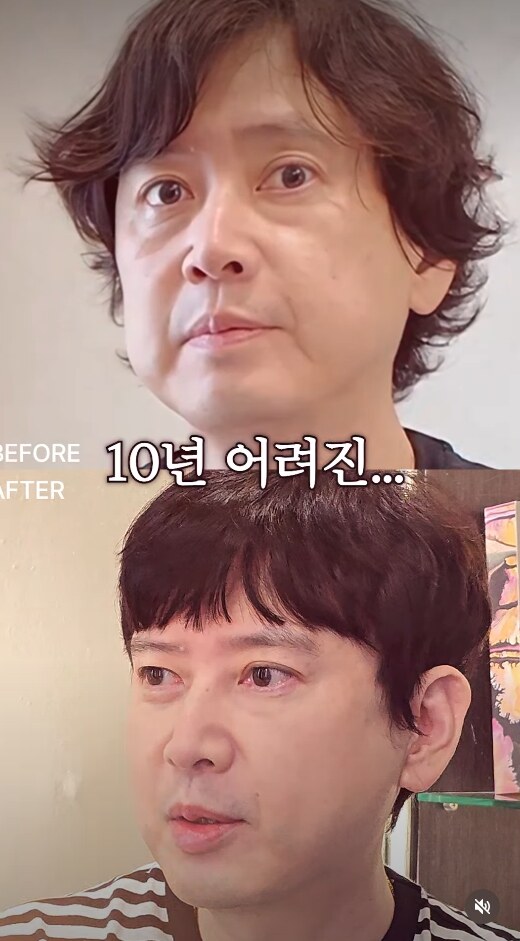 ▲ 배우 김진의 시술 전후 모습이 화제다.&nbsp; 출처ㅣ&nbsp;circleclinic_official 계정