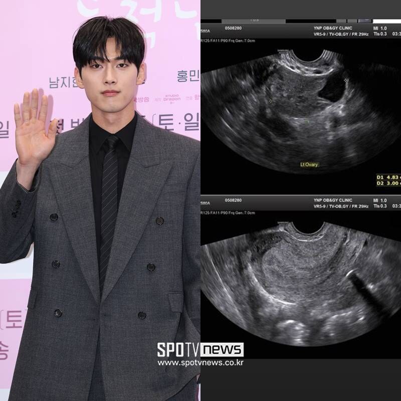 "법정에서 제대로"…초음파·멍 사진 공개한 홍민기 前여친, SNS 폭로전 중단 선언[종합]