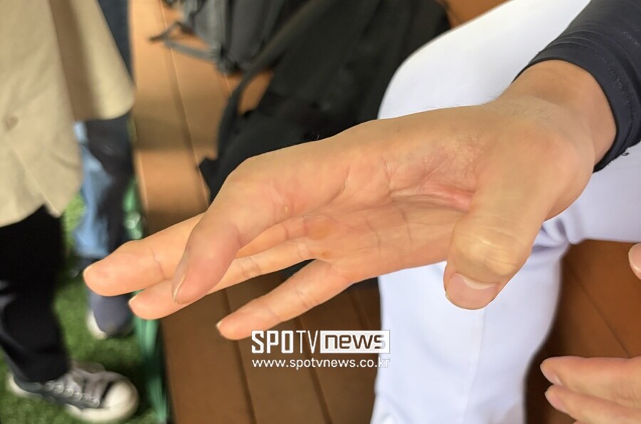 ▲ 박명헌은 긴 재활 끝에 공을 던질 수 있을 정도로 손가락 상태가 좋아졌다고 말했다. ⓒ 신원철 기자