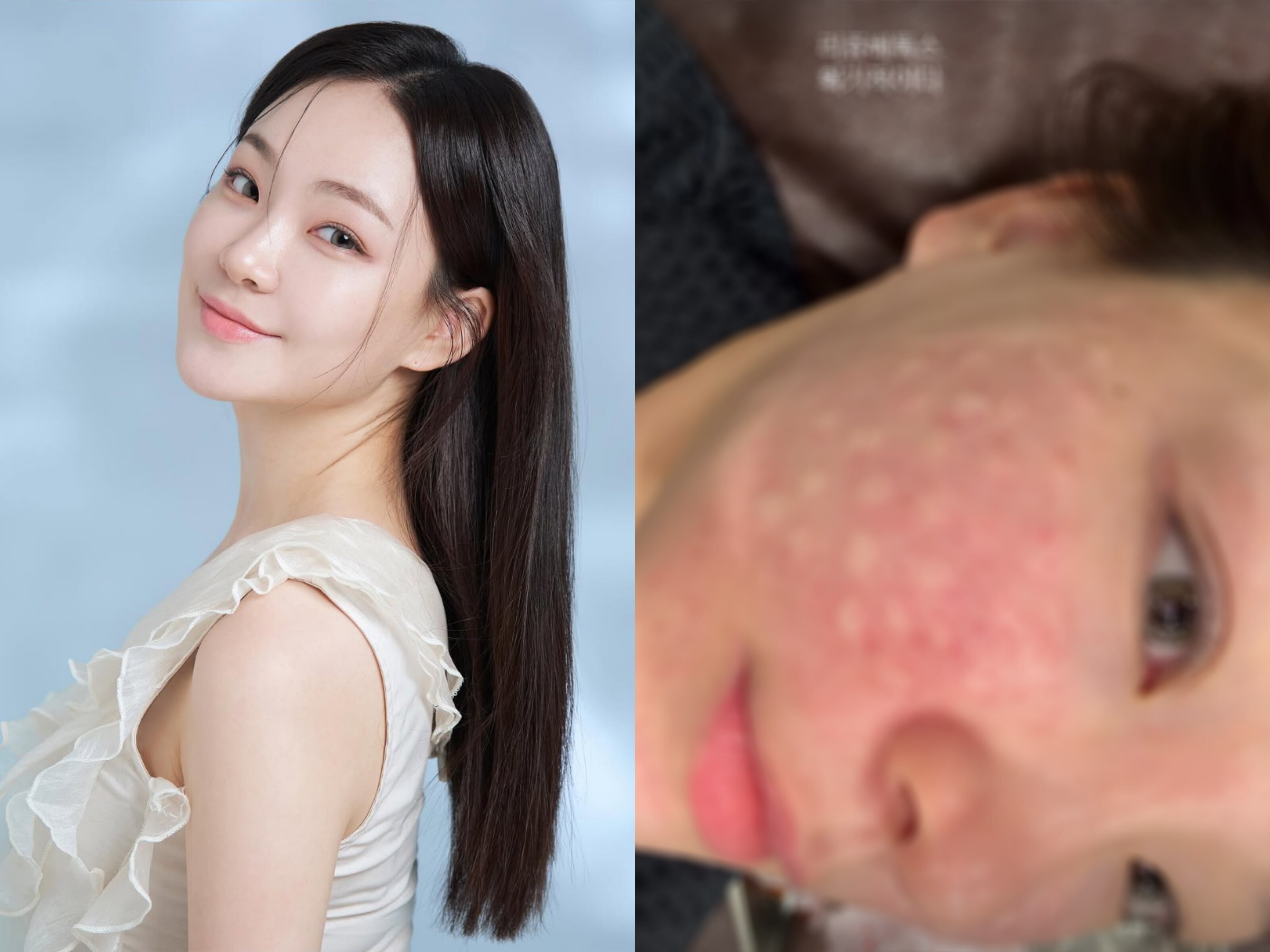 '심규덕♥' 이아영, 얼굴 무슨 일?…빨갛게 부어오른 상처에 팬들 '가슴 철렁'